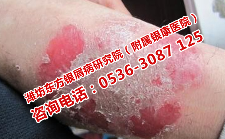 怎样预防牛皮癣反复