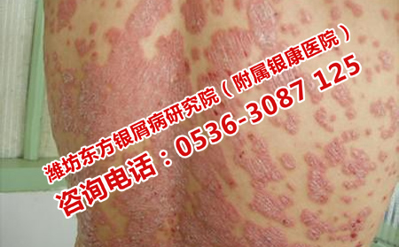 早期治疗银屑病还能恢复吗