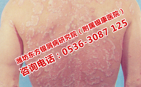 治疗牛皮癣和其他疾病有什么不同