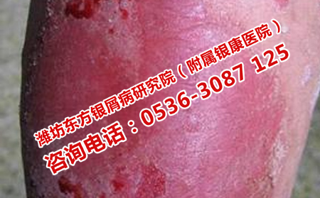 如何更有效的治疗牛皮癣