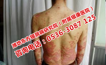 牛皮癣的发病因素有哪些