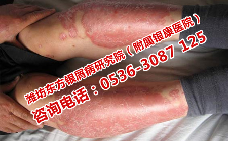 治疗牛皮癣需要多久呢
