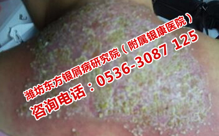 牛皮癣患者适合哪种饮食方式
