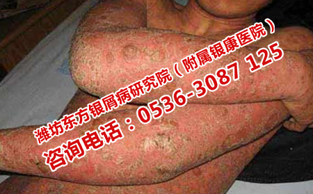 要注意牛皮癣的哪些禁忌