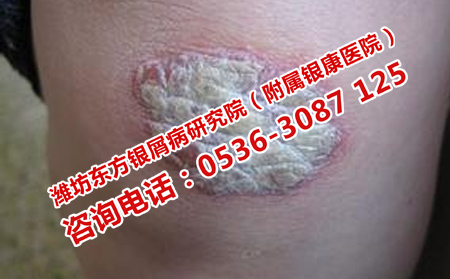 如何正确使用药物治疗牛皮癣
