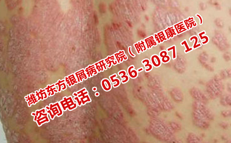 得了牛皮癣要禁忌什么