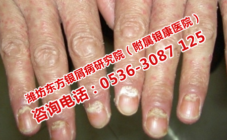 为什么越来越多的人得了牛皮癣