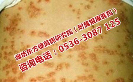 牛皮癣患者夏季如何饮食