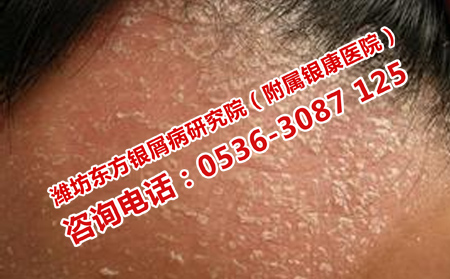 牛皮癣是不是不治之症
