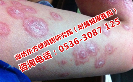 吃什么对牛皮癣患者身体可以