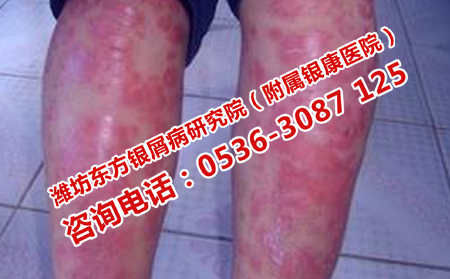 牛皮癣的遗传可以避免吗