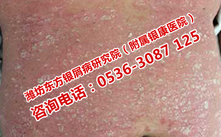 牛皮攒恢复指南