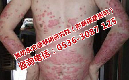 牛皮癣初期治疗难度大吗