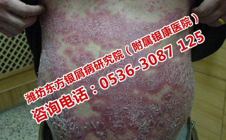 如何治疗多年的顽固牛皮癣