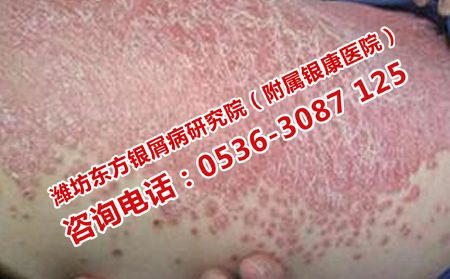 牛皮癣长久性发作的危害