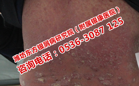 银屑病不会传染患者不必多心