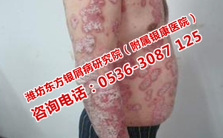 潍坊银屑病医院紫外线治疗