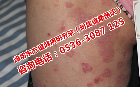牛皮癣该如何治疗