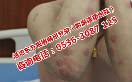 银屑病治疗恢复药品