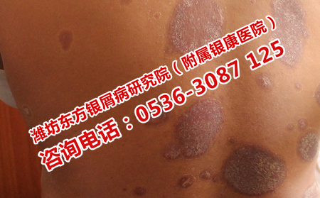 治疗牛皮癣中医专科