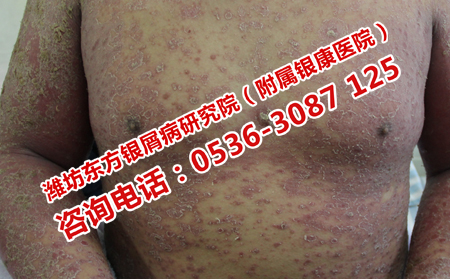 潍坊东方银屑病研究院治疗银屑病