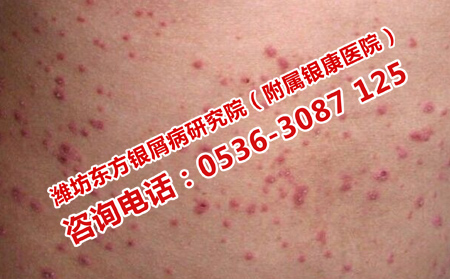 银屑病症状加重的原因