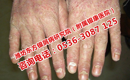 患上关节型银屑病怎么办