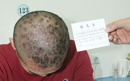 治疗儿童银屑病