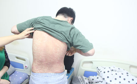 银屑病在治疗禁忌