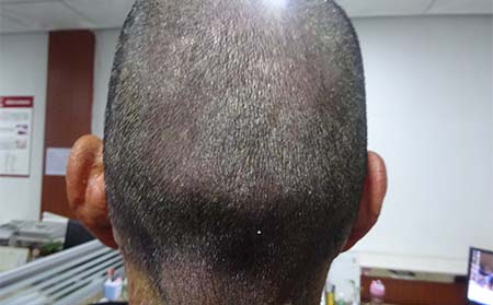 牛皮癣治疗