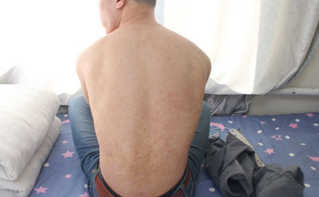 寻常型银屑病治疗方法