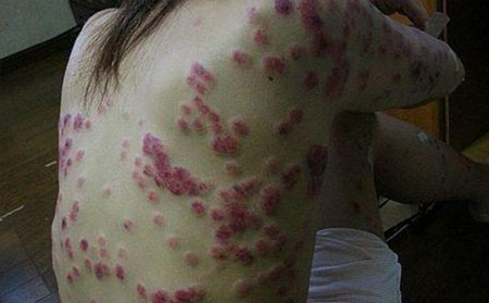 银屑病患者瘙痒