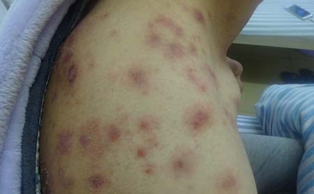 银屑病治疗方式