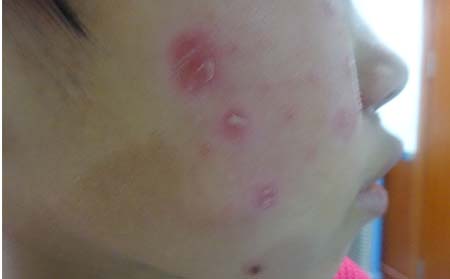 银屑病治疗方式介绍