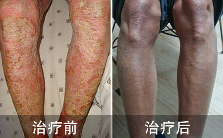 你要了解的常识：什么是银屑病的同形反应