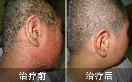 如何才能对牛皮癣进行“准确打击” 外用药膏不可盲目用