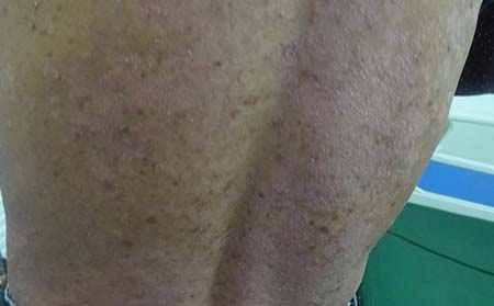 怎么预防银屑病复发