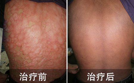 银屑病应该怎么治疗
