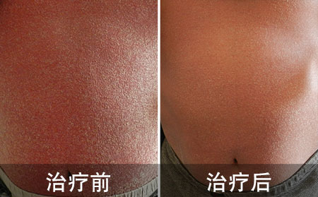治疗银屑病用什么方法