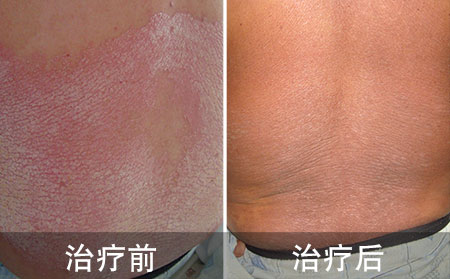 银屑病应该怎么治疗