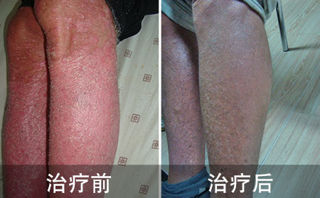 治疗银屑病的方法有什么