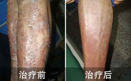 银屑病应该怎么治疗