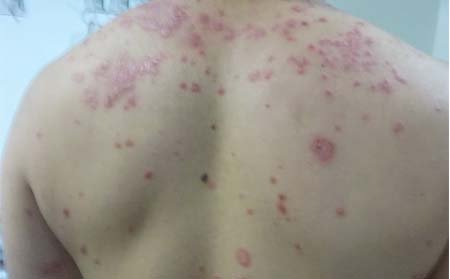 银屑病应该怎么预防