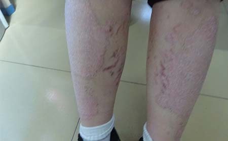 银屑病恢复的症状有什么