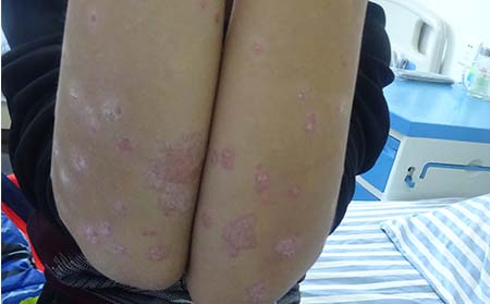 银屑病对患者有什么危害