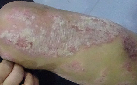 什么样的症状是银屑病