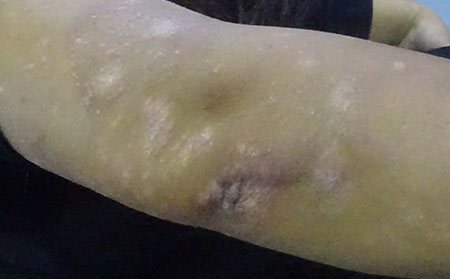 银屑病的主要危害有什么