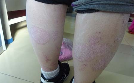银屑病应该怎么进行治疗
