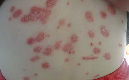 银屑病应该怎么进行护理