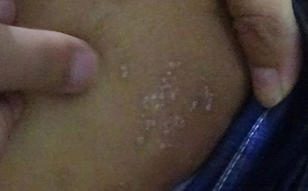 银屑病应该怎么进行护理